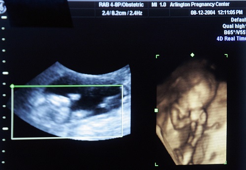 Phẫu thuật tim cho thai nhi nằm trong bụng mẹ